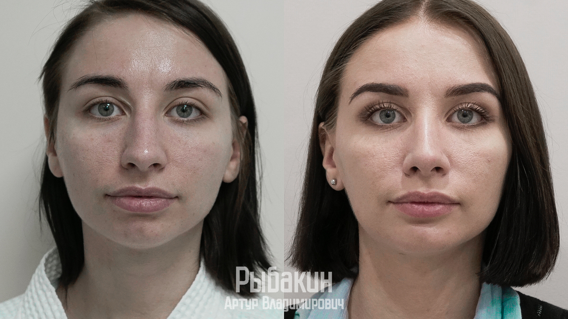 Ринопластика лица до и после фото